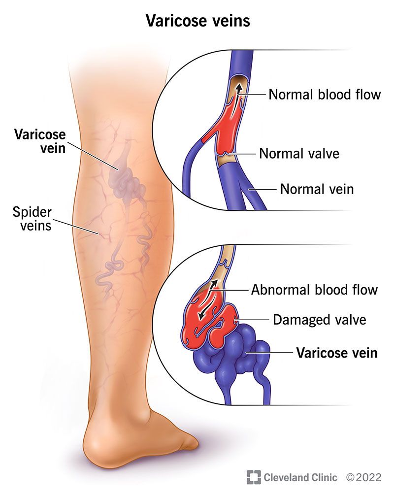 Varicose Veins Causes And Treatment