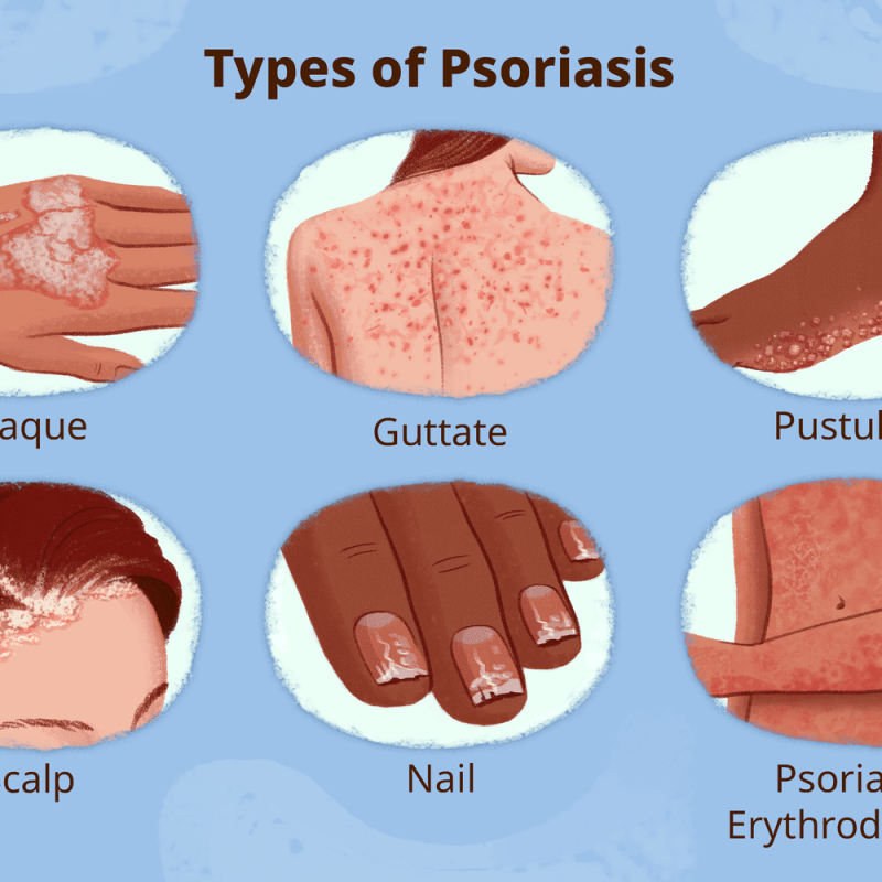 Types of Psoriasis